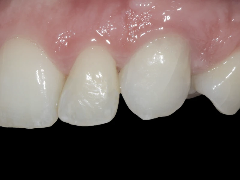 Nachher: Nahaufnahme oberer Eckzahn nach dem Internen Bleaching Fall 2.