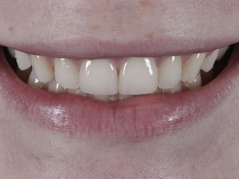 Nachher: Nahaufnahme der Frontzähne nach der Behandlung mit Veneers Fall 2.
