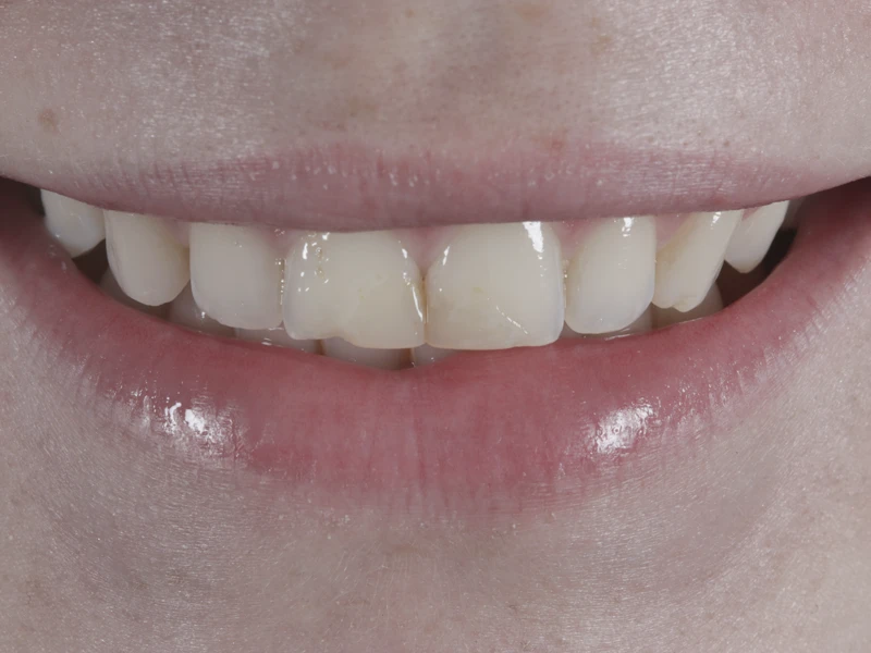 Vorher: Nahaufnahme der Frontzähne vor der Behandlung mit Veneers Fall 2.