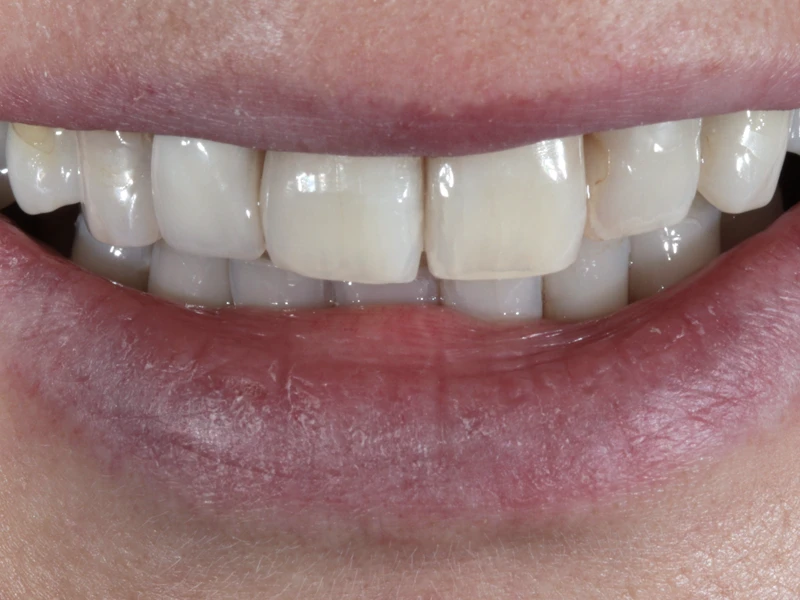 Vorher: Nahaufnahme der Frontzähne vor der Behandlung mit Veneers Fall 1.
