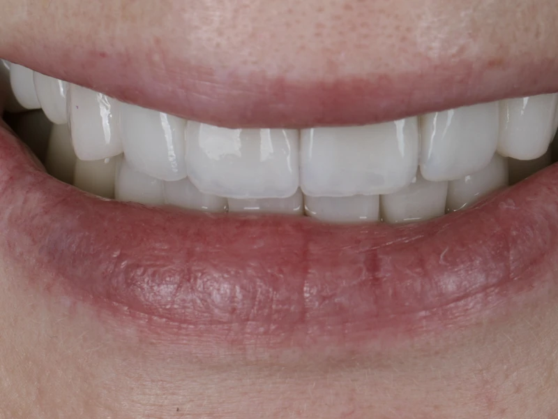 Nachher: Nahaufnahme der Frontzähne nach der Behandlung mit Veneers Fall 1.